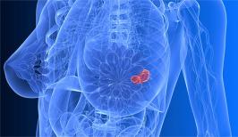 Топ вопросов про рак молочной железы 